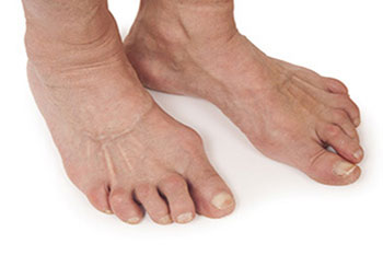 arthritic foot care