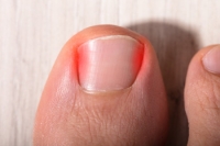 Infections From Ingrown Toenails