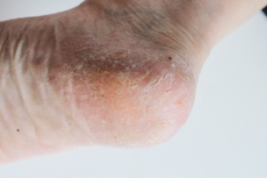 Cracked Heels Relief