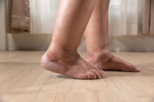 Causes of Swelling in the Legs and Feet