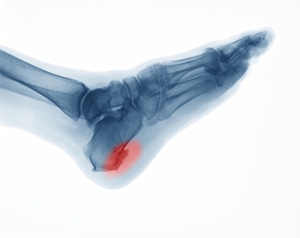 Medical Insights on Heel Spurs