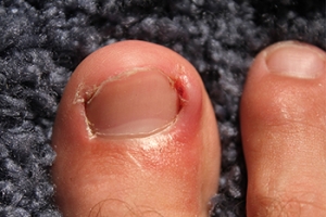 Ingrown Toenails and Salt