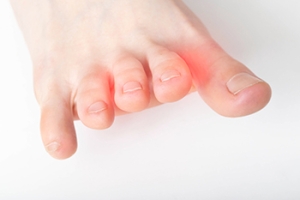 High Heels and Morton’s Neuroma