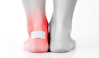 Types of Foot Blisters