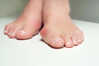Reasons Bunions May Develop